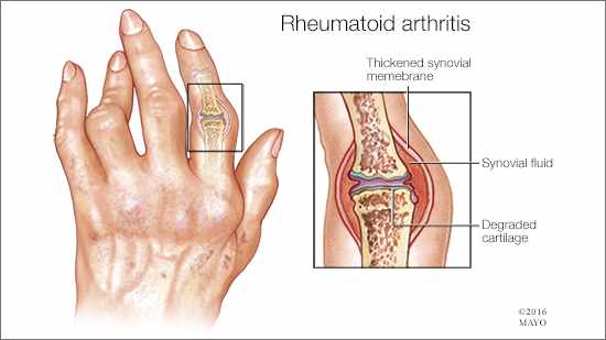 Joint protection for people with hand arthritis - Mayo Clinic